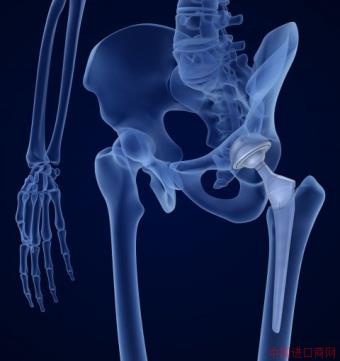 illustration of hip bone implant