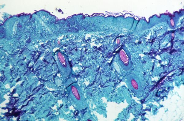 A section of skin tissue, harvested from a lesion on the skin of a monkey, that had been infected with mo<em></em>nkeypox virus