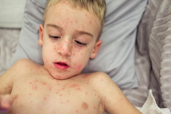 The US Centre for Disease Co<em></em>ntrol estimates one to two in 1,000 children infected will die