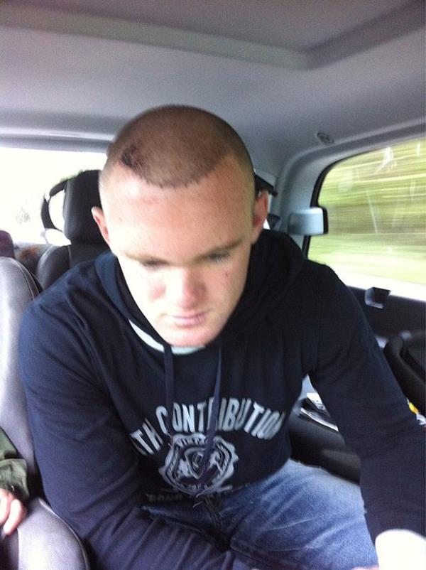 Wayne Roo<em></em>ney June 2011 posted a picture on Twitter showing off his new hair transplant