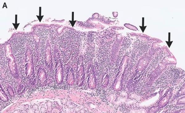 A section of the man's intestine as shown under a microscope